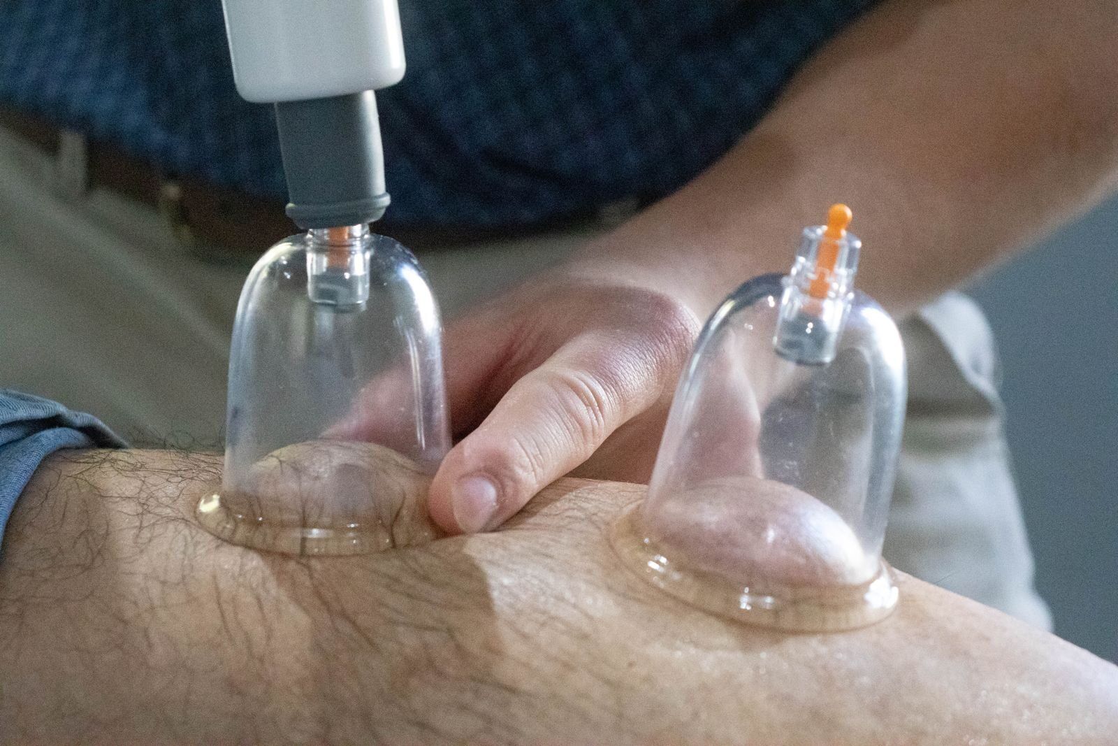 Cupping Therapy at Peak Physiotherapy, Mayville, Pretoria